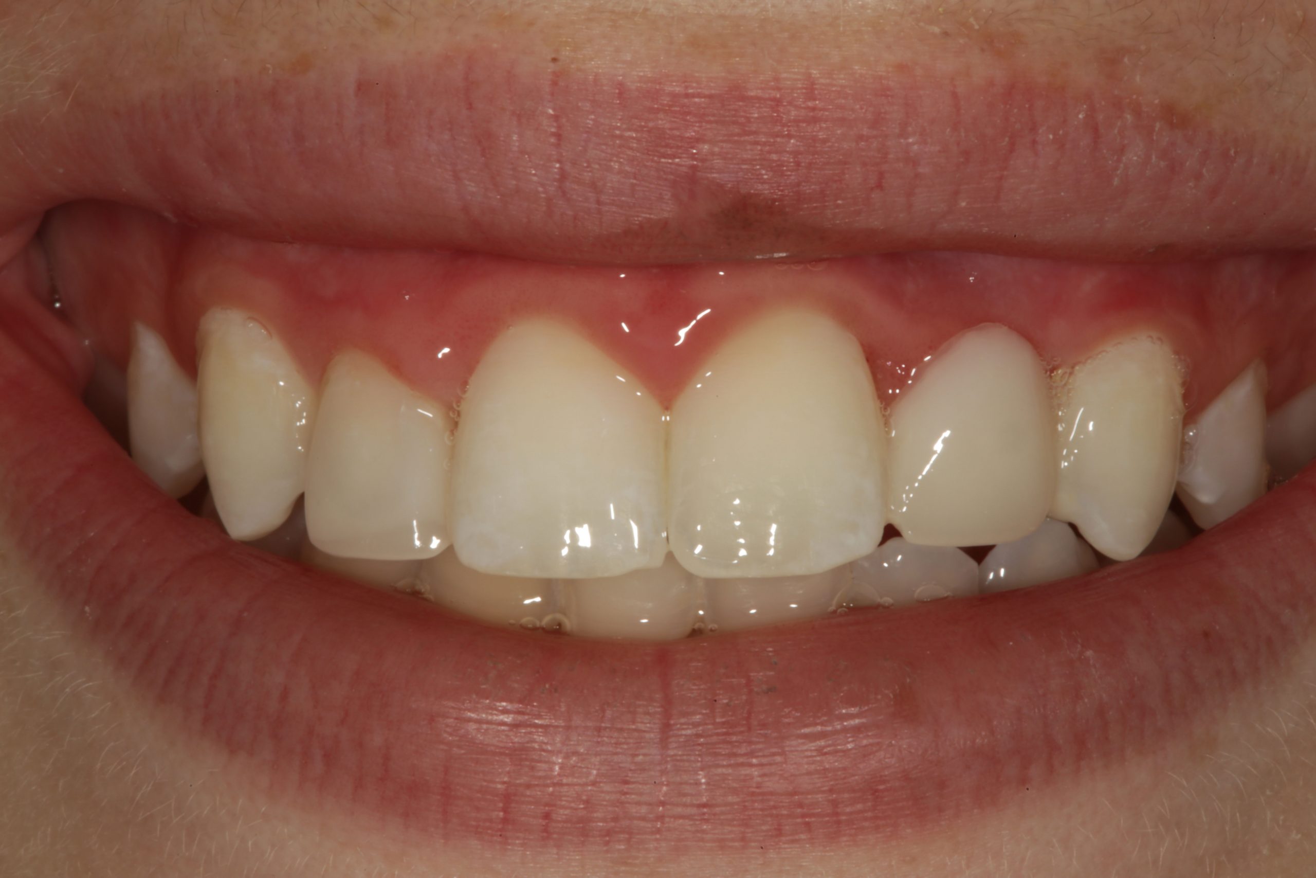 Uveneer: Simplifying Artistic Direct Composite Veneering - Dentistry Today